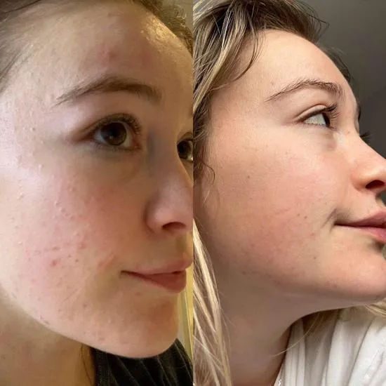 Douvall's Argan Acne Rehab Serum 30ml