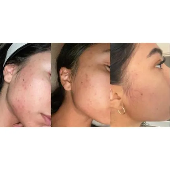 Douvall's Argan Acne Rehab Serum 30ml