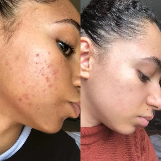 Douvall's Argan Acne Rehab Serum 30ml