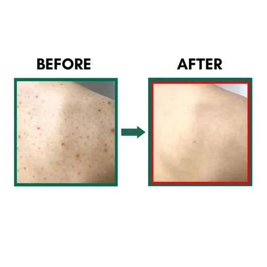 Some by Mi AHA-BHA-PHA 30 Days Miracle Acne Clear Body Cleanser 400g