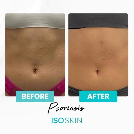 ISOCLEAN ISOSKIN Hypochlorous Spray 275ml