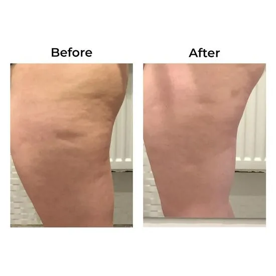 Skinade Targeted Solutions Cellulite