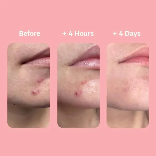 SVR SEBIACLEAR 4hr Gel Flash 15ml