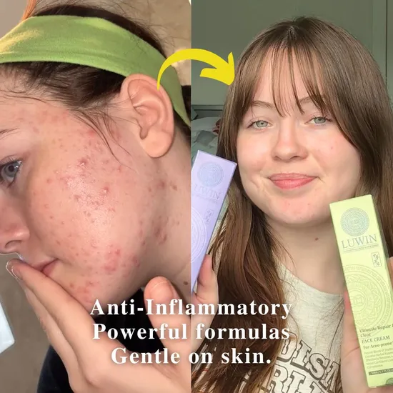 LUWIN Ultimate Repair & Clear Face Cream For Acne-prone Skin 50ml