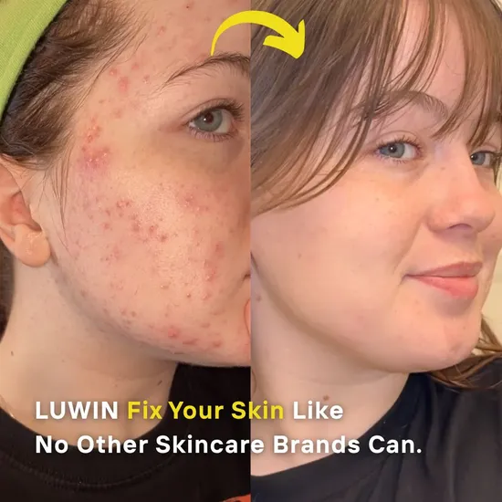 LUWIN Ultimate Repair & Clear Face Cream For Acne-prone Skin 50ml