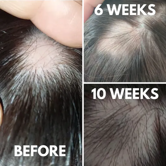 Hair Loving Derma Roller For Hair Growth