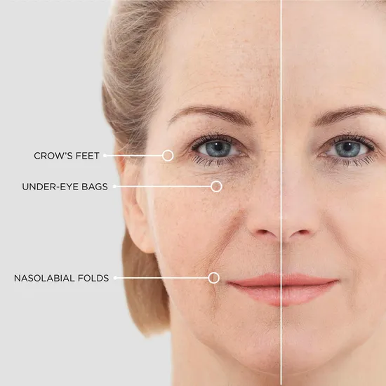 BEAUTICAL Microneedle Eye Patches