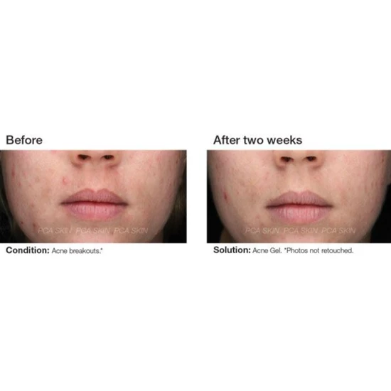 PCA SKIN Acne Gel 29.5ml