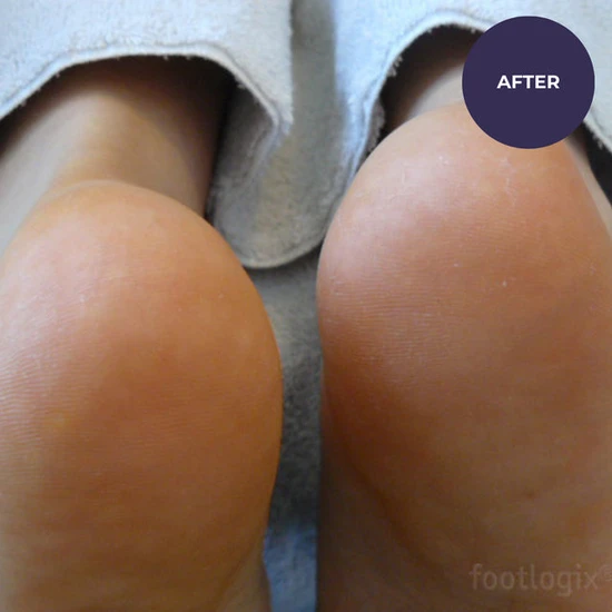 Footlogix Very Dry Skin Formula 125ml