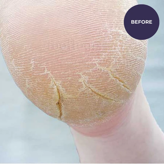 Footlogix Cracked Heel Formula 125ml
