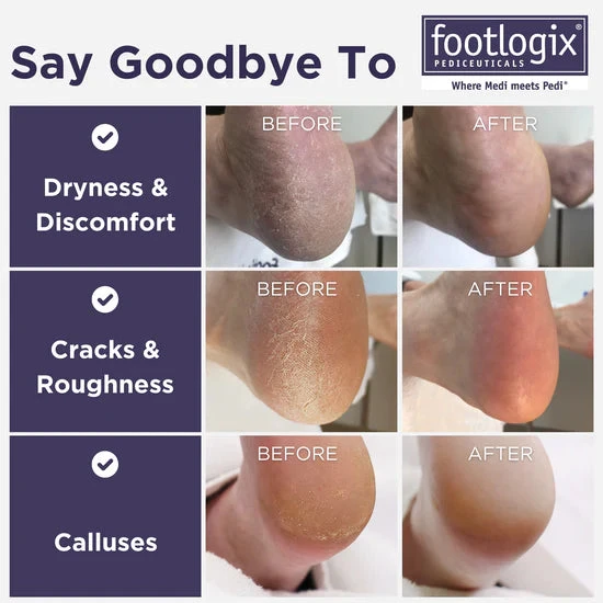 Footlogix Ultimate "at Home" Foot Care Combo 100ml