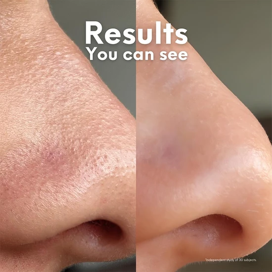Skin Choice Breakout Patch Classic Nose