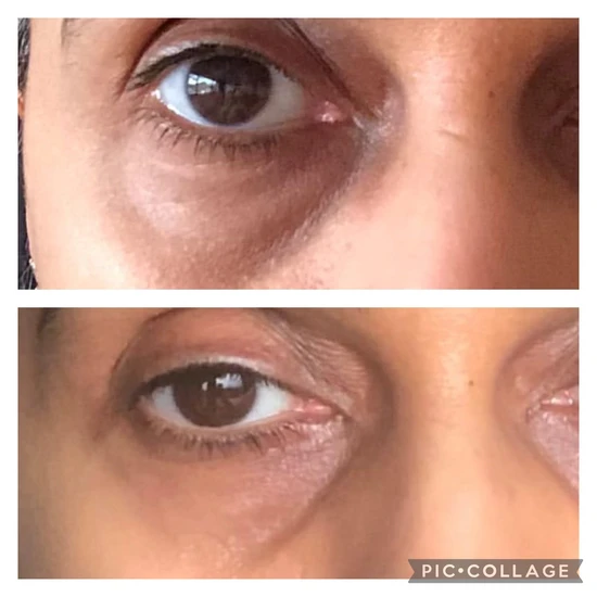 Soloskinlondon Soloskin London Dark Circles Under Eye Oil 10ml