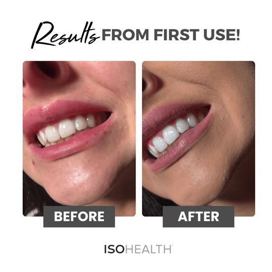 ISOCLEAN ISOHEALTH Teeth Whitening Strips Available In Clear Or Carbon Clear