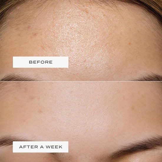 Vue Hydrocolloid Forehead Patches x5