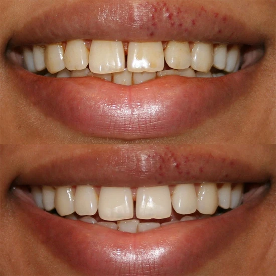 Smile Science Harley Street Professional Teeth Whitening Refill