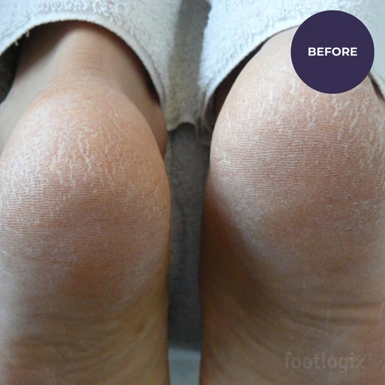 Footlogix Very Dry Skin Formula 125ml