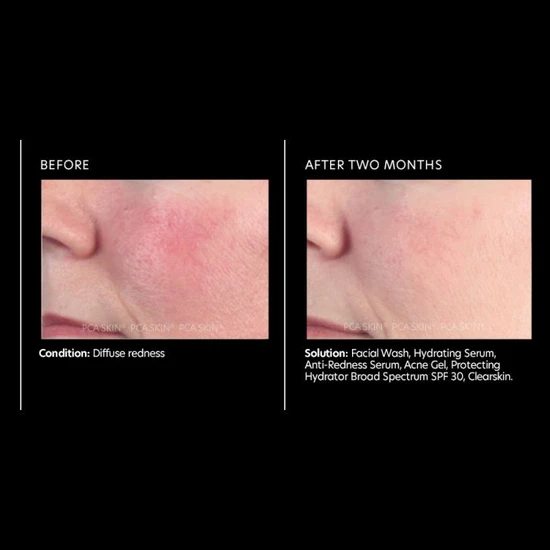 PCA SKIN Anti-Redness Serum 29.5ml