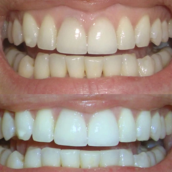 Smile Science Harley Street Professional Duo Cleaning & Whitening Foams 2 x 50ml