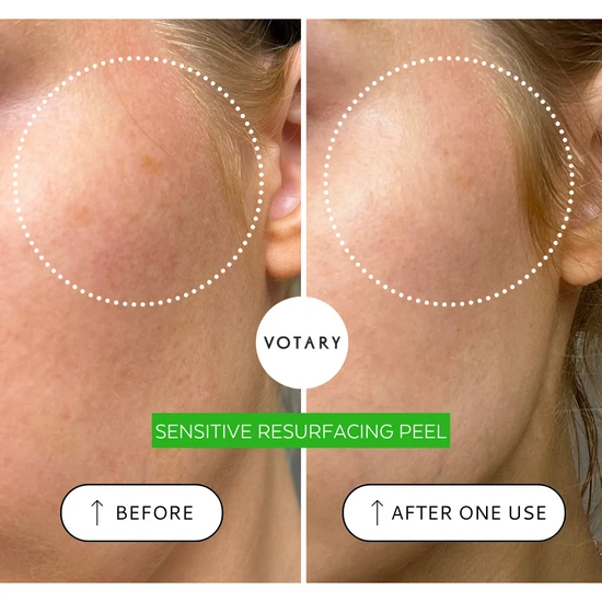 Votary Sensitive Resurfacing Peel 30ml