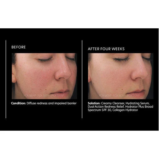 PCA SKIN Dual Action Redness Relief 30ml