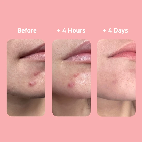 SVR SEBIACLEAR 4hr Gel Flash 15ml