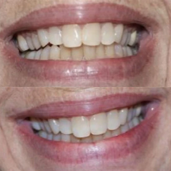 Smile Science Harley Street Professional Organic Activated Charcoal Teeth Whitening Powder