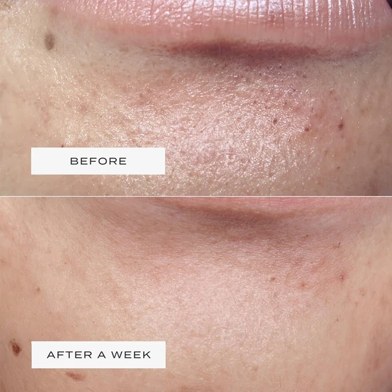 Vue Hydrocolloid Chin Patches 8 Patches