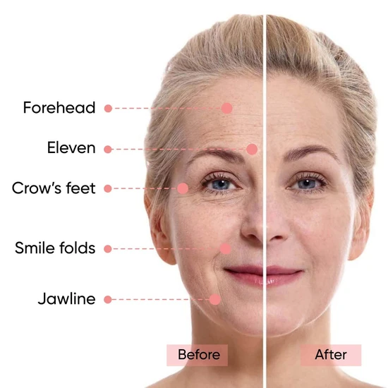 Sensica Sensilift Skin tightening anti-ageing treatment