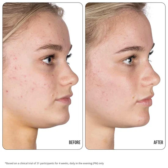 NIP+FAB Retinol Fix Blemish Gel Treatment 10% 15ml