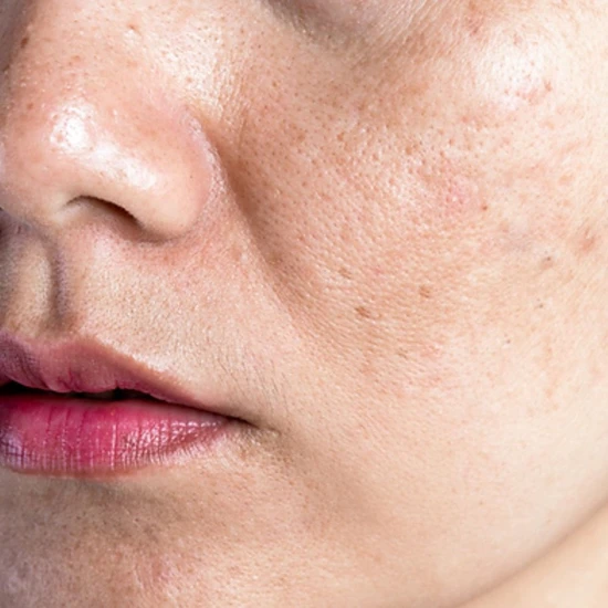 RVB Lab Meso Fill Peel & Bright Tri-Acid Micro-Peel 50ml