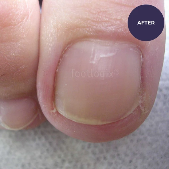 Footlogix Toe Nail Tincture 50ml