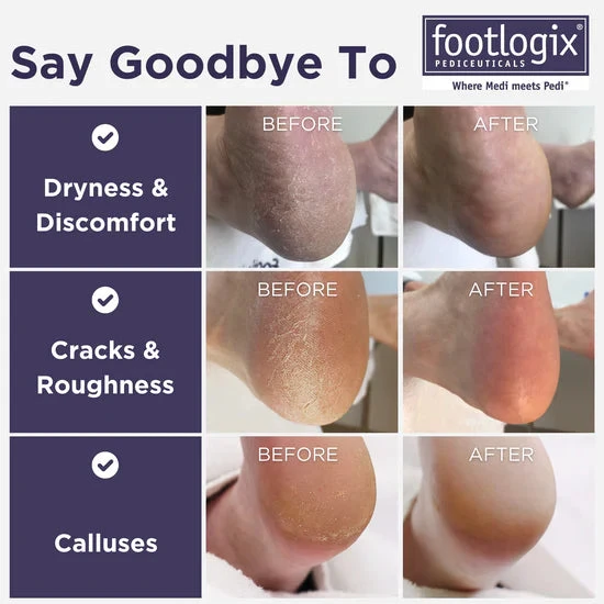 Footlogix Ultimate "at Home" Foot Care Combo 100ml